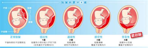 前置胎盤原因|馬偕紀念醫院 衛教單張：前置胎盤